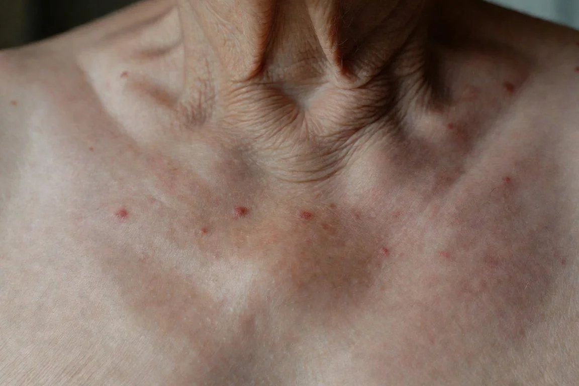 tipos manchas rojas pecho angiomas edad exposicion solar