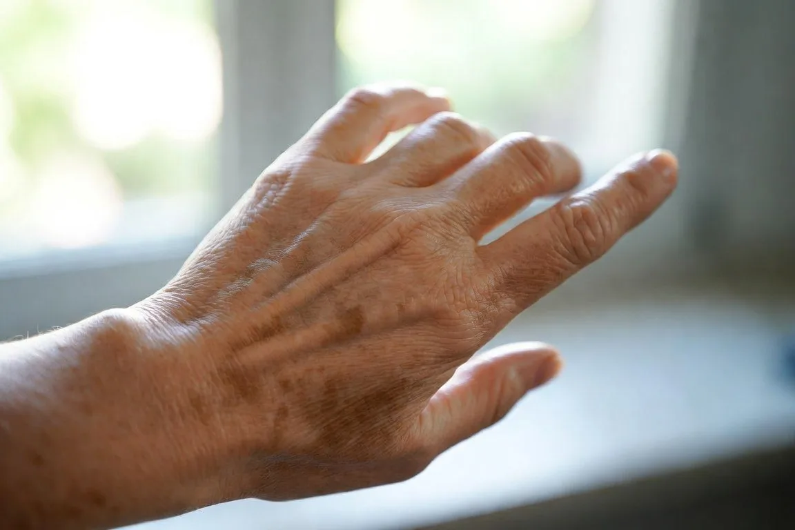 manchas marrones en mano mujer exposicion solar piel
