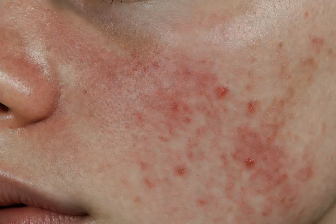 manchas rojas en la cara causas sol y pigmentación