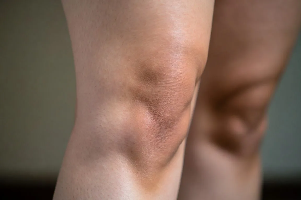 rodilla hinchada inflamacion visible primer plano
